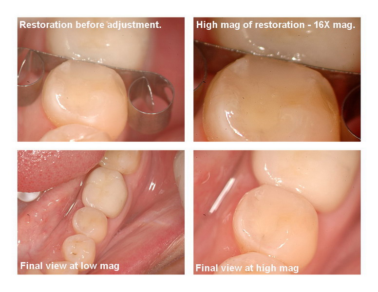 Amalgam removal 6_resize.jpg